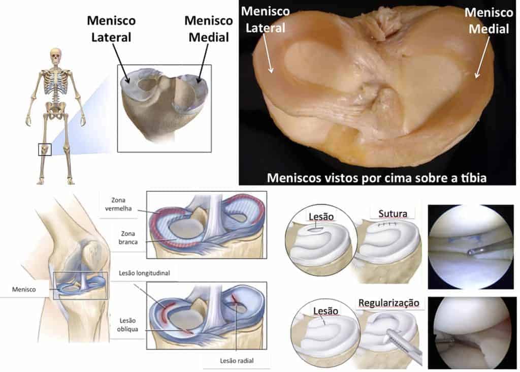 LesÃ£o, Sutura e RegularizaÃ§Ã£o do Menisco Lateral e Menisco Medial