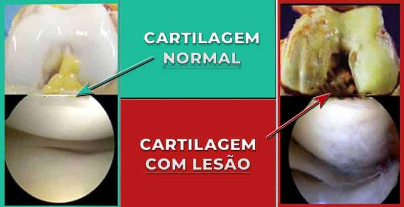 Cartilagem com LesÃ£o