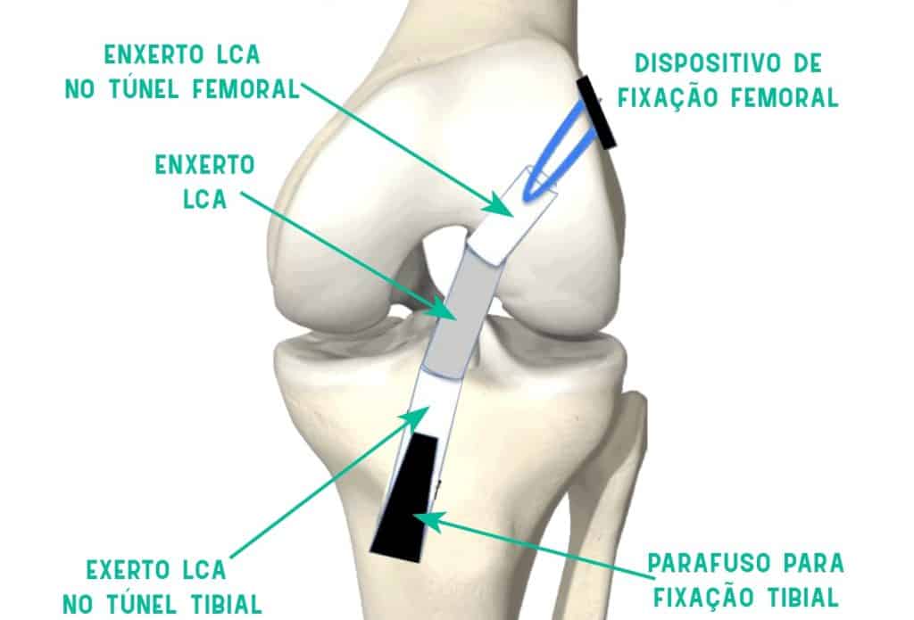 Ligamento Cruzado Anterior Rompido sendo corrigido por Enxerto LCA no tÃºnel femoral e tibial por meio de um dispositivo de fixaÃ§Ã£o femoral e tibial