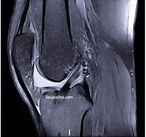 Ressonância magnética ligamento cruzado anterior reconstruiÌdo Ressonancia magnetica mostrando ligamento cruzado anterior do joelho reconstruido de maneira anatomica